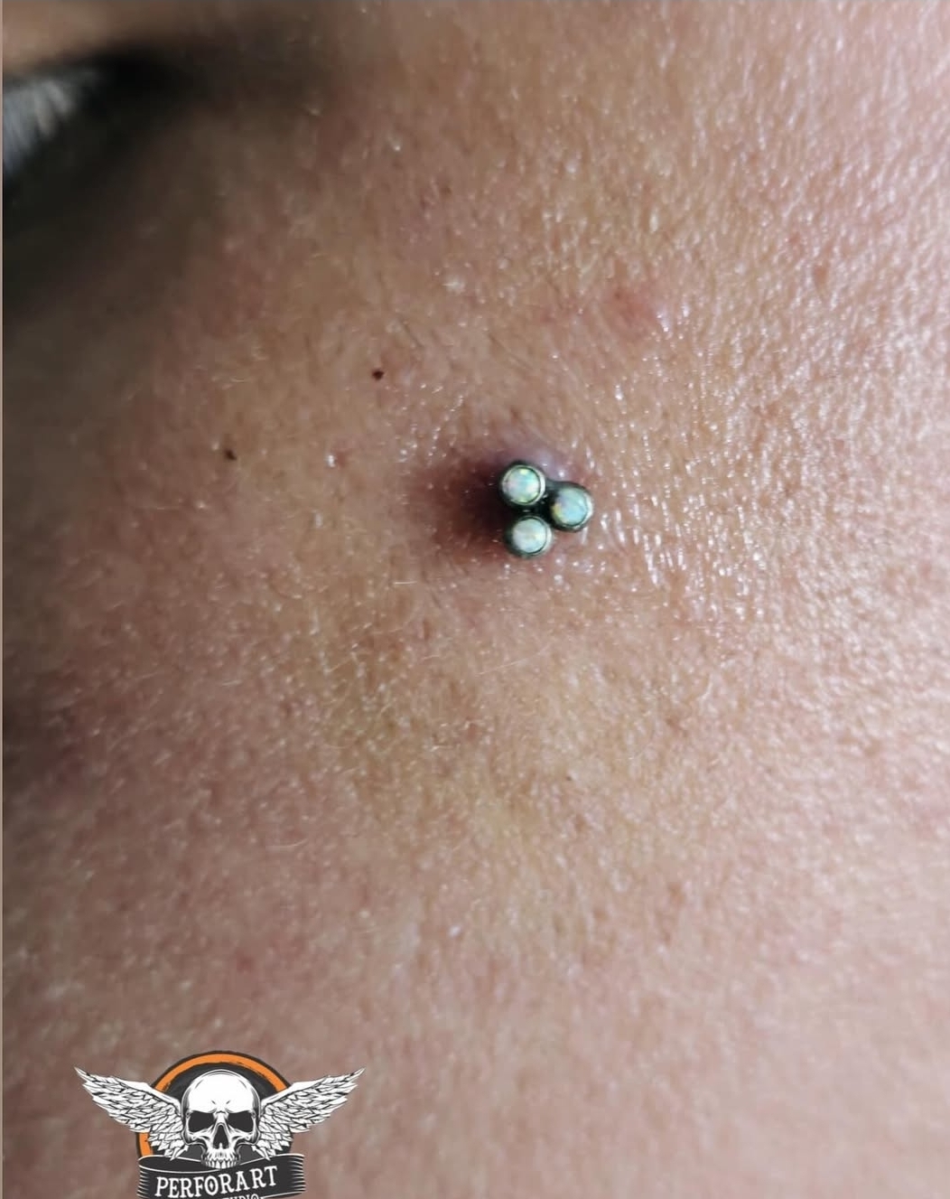 Microdermal